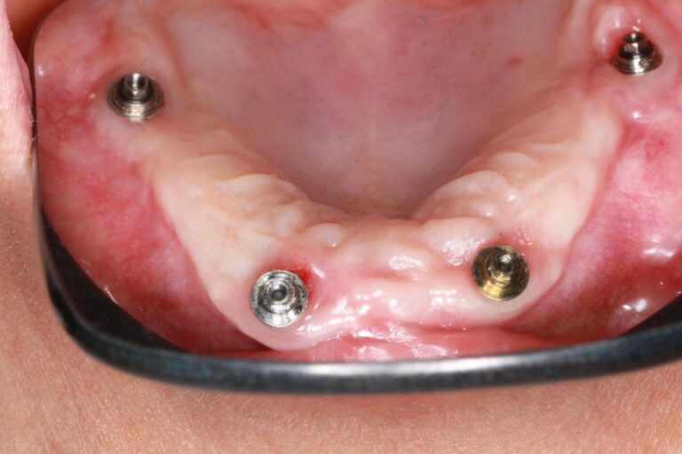implants zygomatiques